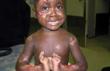 Million of children that survive burn injuries live with life long disabilities, scars and stigma.
